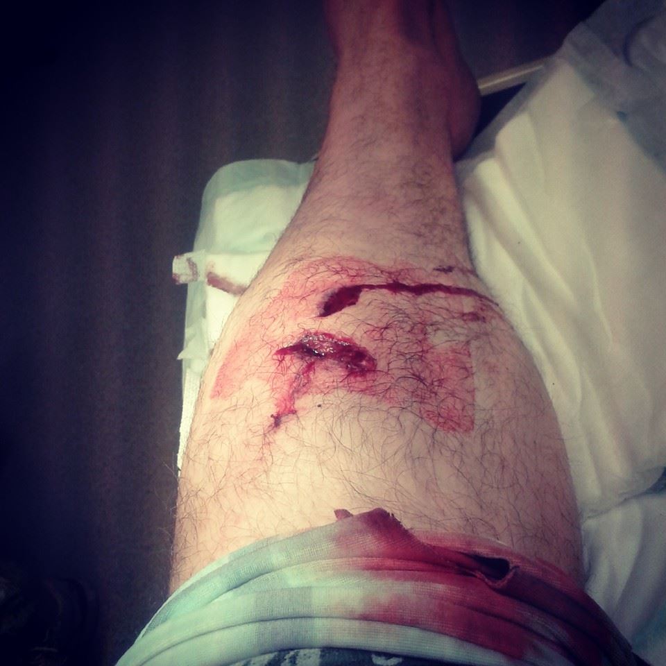 Zraněná noha Ondřeje Banka (foto: Ondřej Bank)